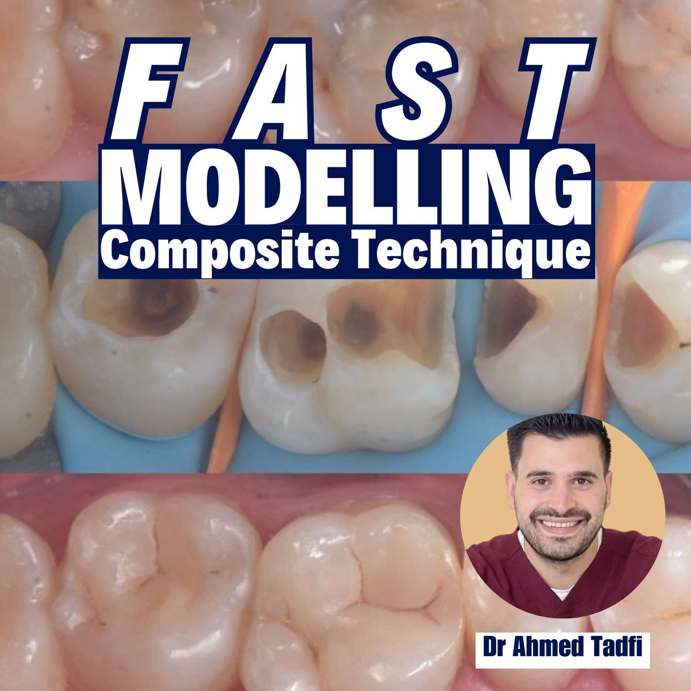 The Fast Modelling Technique for Efficient and Esthetic Posterior Composites – PDP177 episode artwork