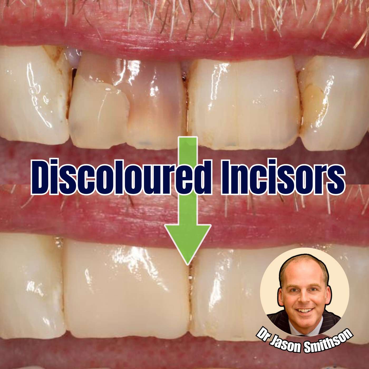 Discoloured Centrals Incisors with Jason Smithson – PDP191 episode artwork