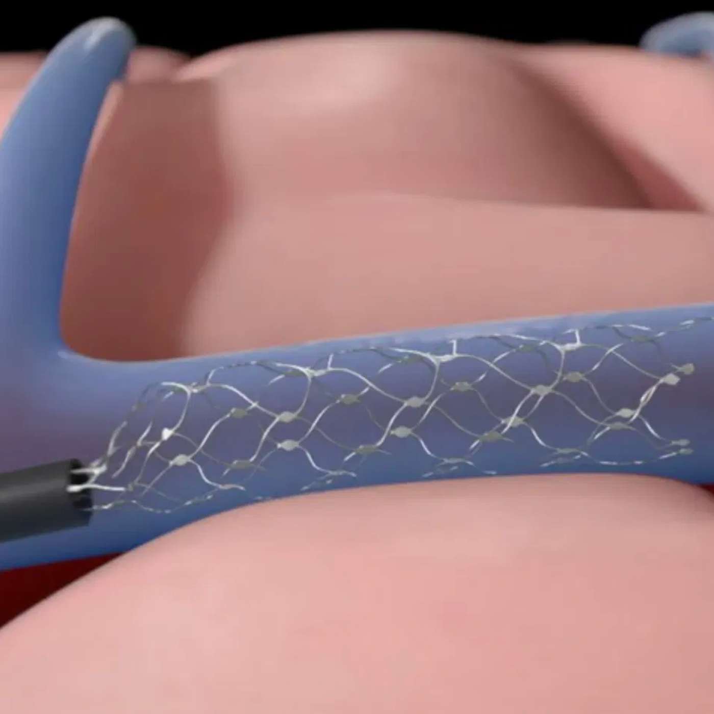 Synchron Revolutionizes Assistive Tech, Raven Software Workers Unionize, Spotify Increases Premium Prices, Google Cuts AI Power Use, and more...