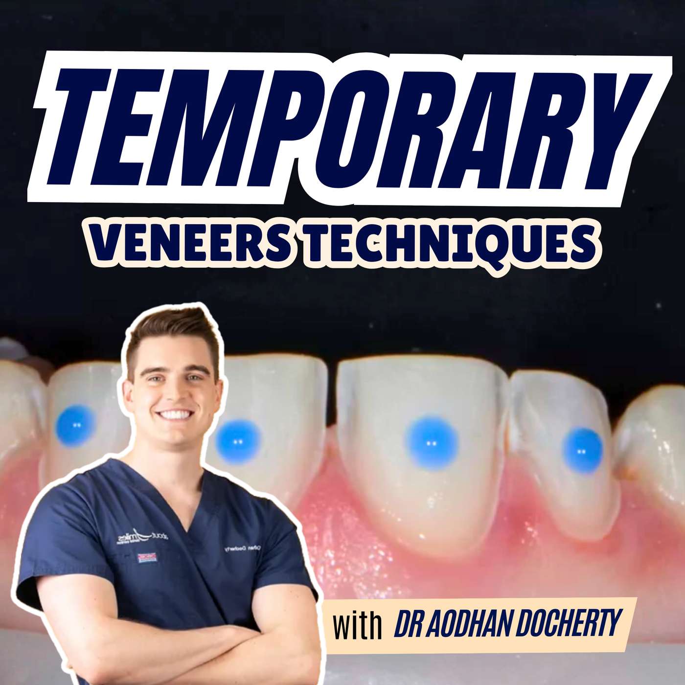 How to Temporise Veneers Step by Step FULL GUIDE – PDP214 episode artwork