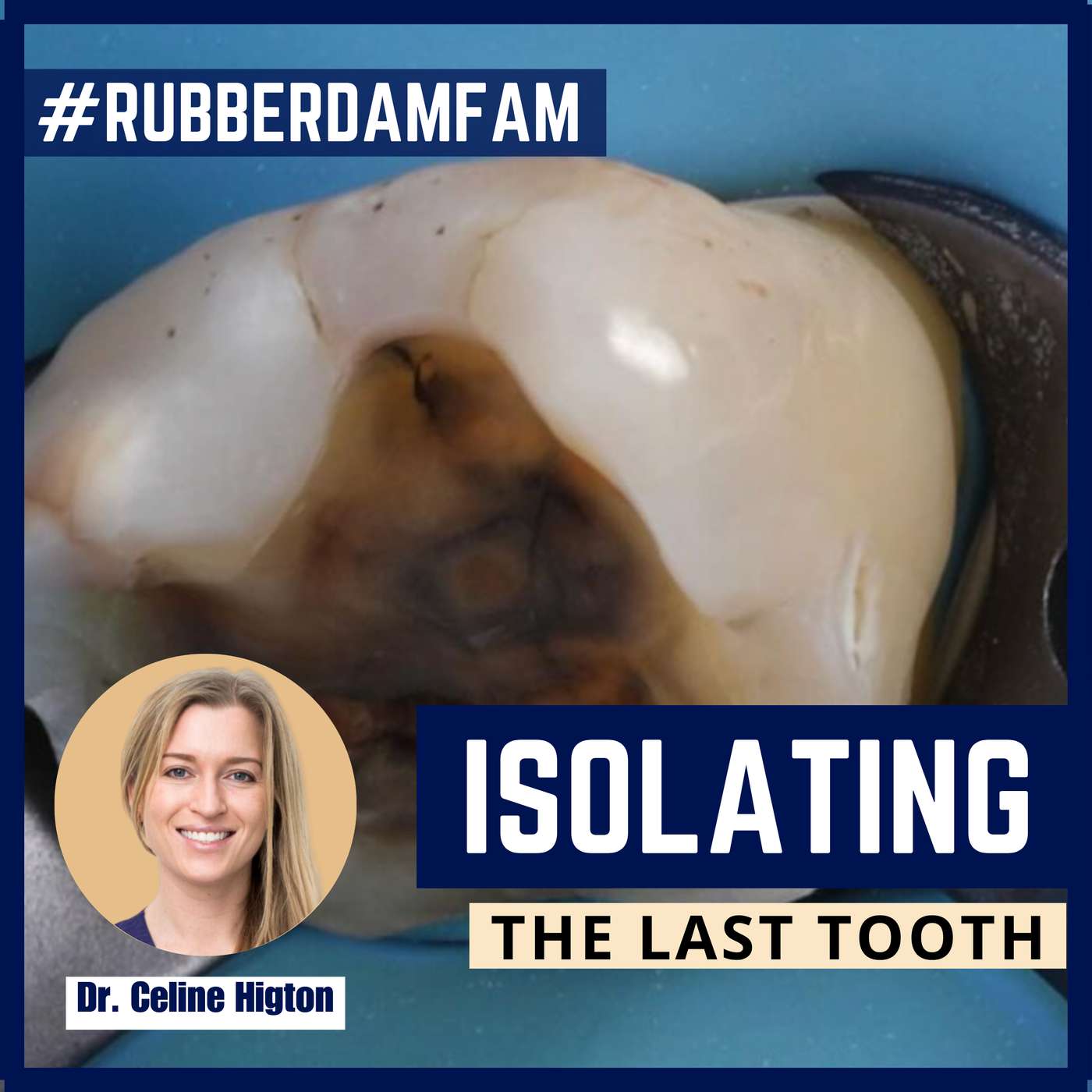 Isolating the Last Tooth in the Arch #RubberDamFam – PDP183 episode artwork
