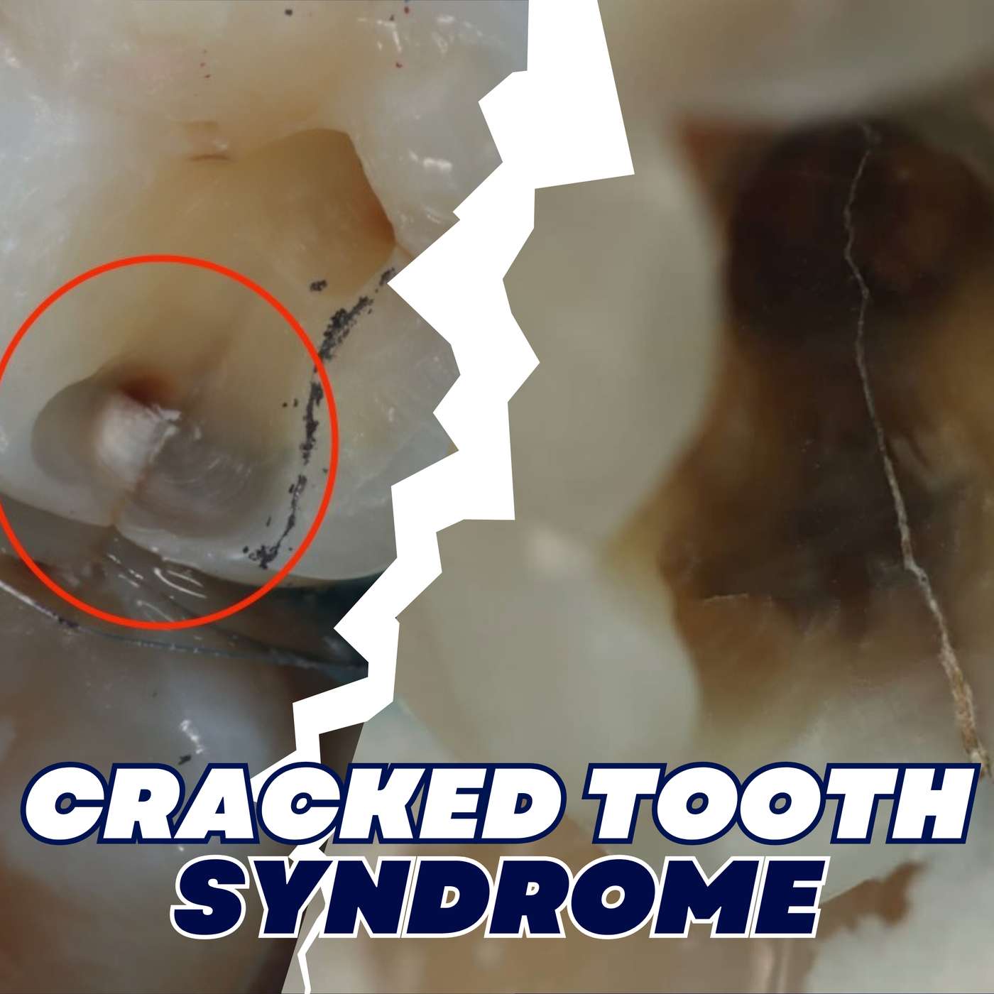 Understanding Cracked Tooth Syndrome and the Dental Occlusion Triad – PS019
