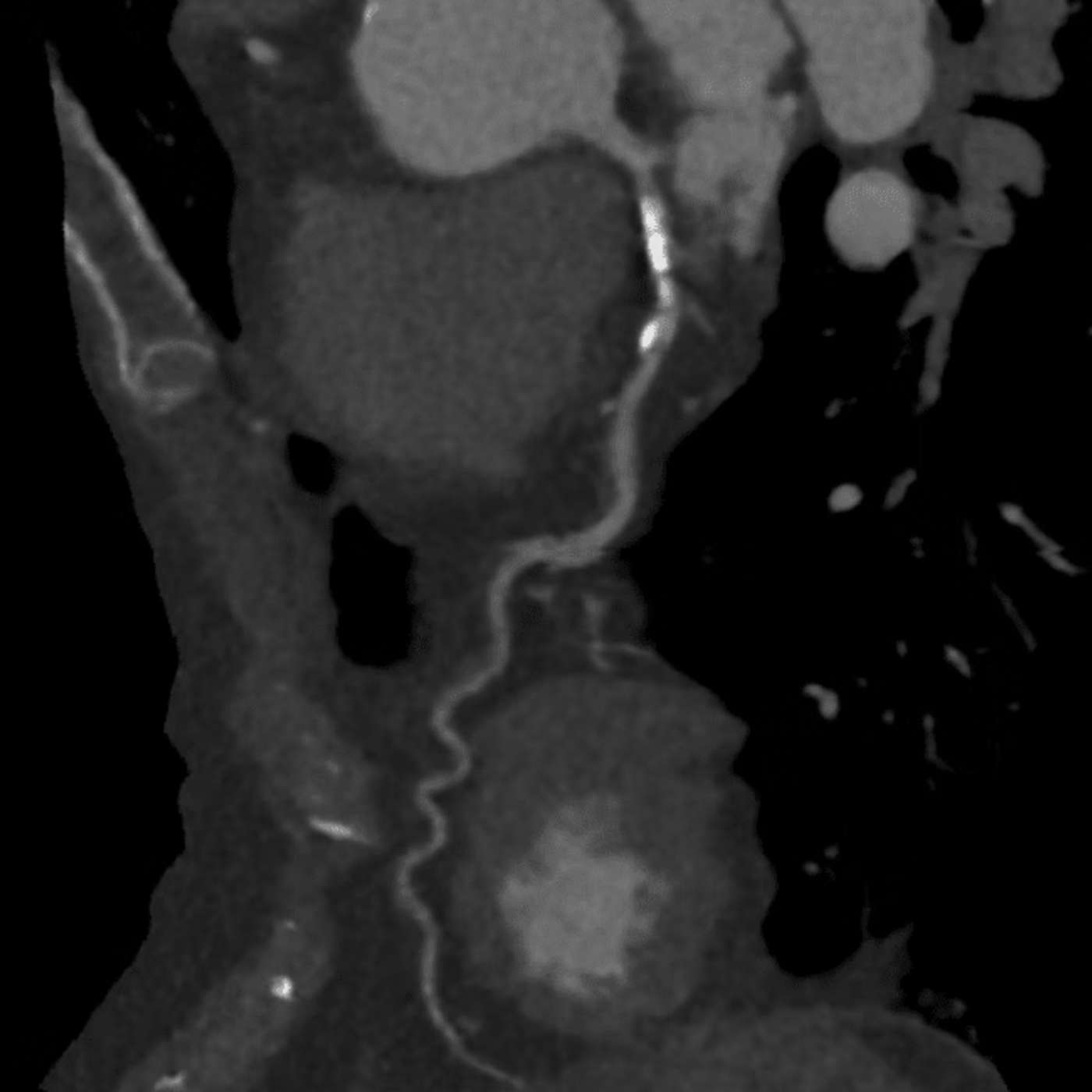 Is coronary artery calcification good or bad? episode artwork