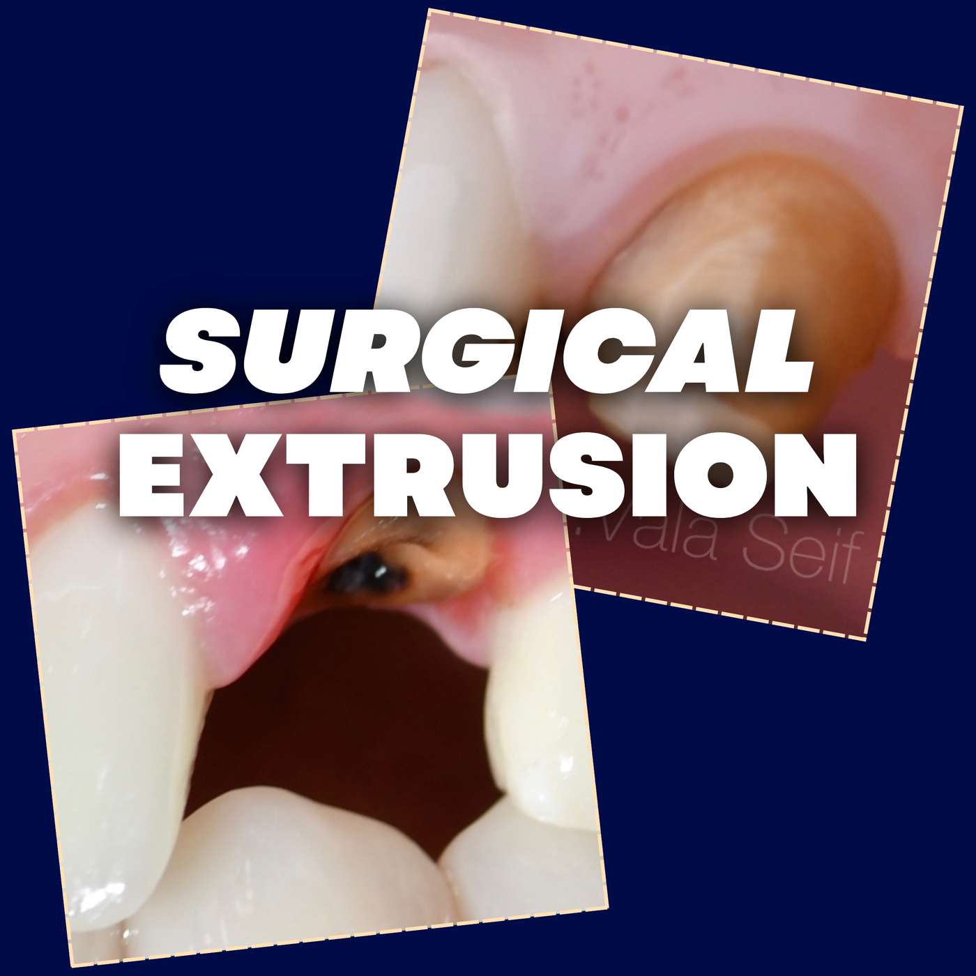 Surgical Extrusion Technique Update – Alternative to Ortho Extrusion or CLS – PDP249