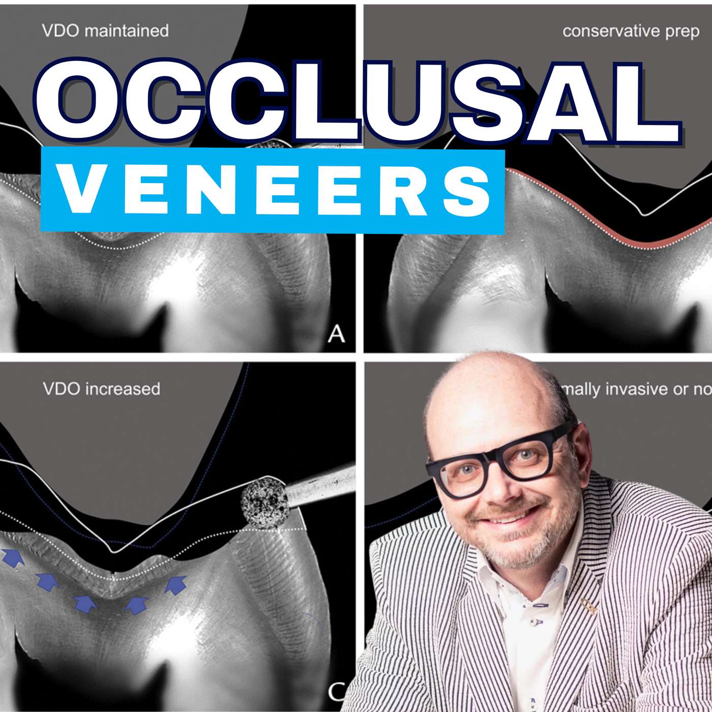 Pascal Magne on Occlusal Veneers and Material Selection – PDP221 episode artwork