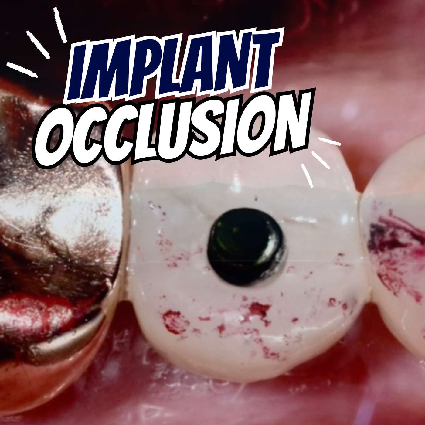 Implant Occlusion that Makes Sense! – PDP204 episode artwork