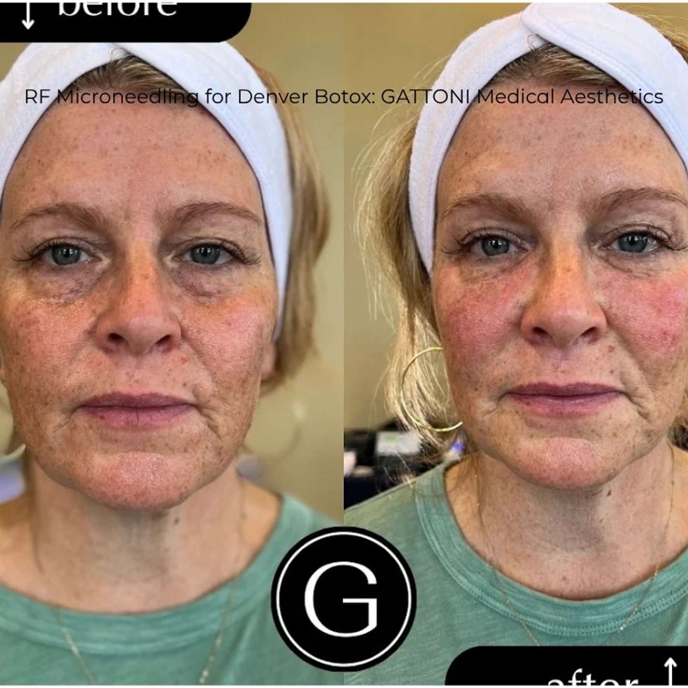 Play RF Microneedling for Denver Botox: GATTONI Medical Aesthetics