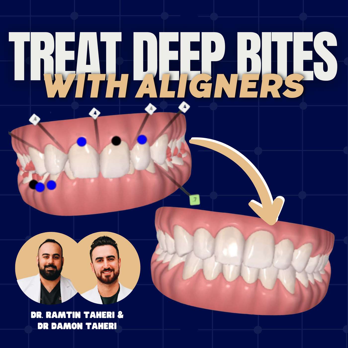 Deep Bites and Aligners – How to Improve Predictability – PDP170 episode artwork