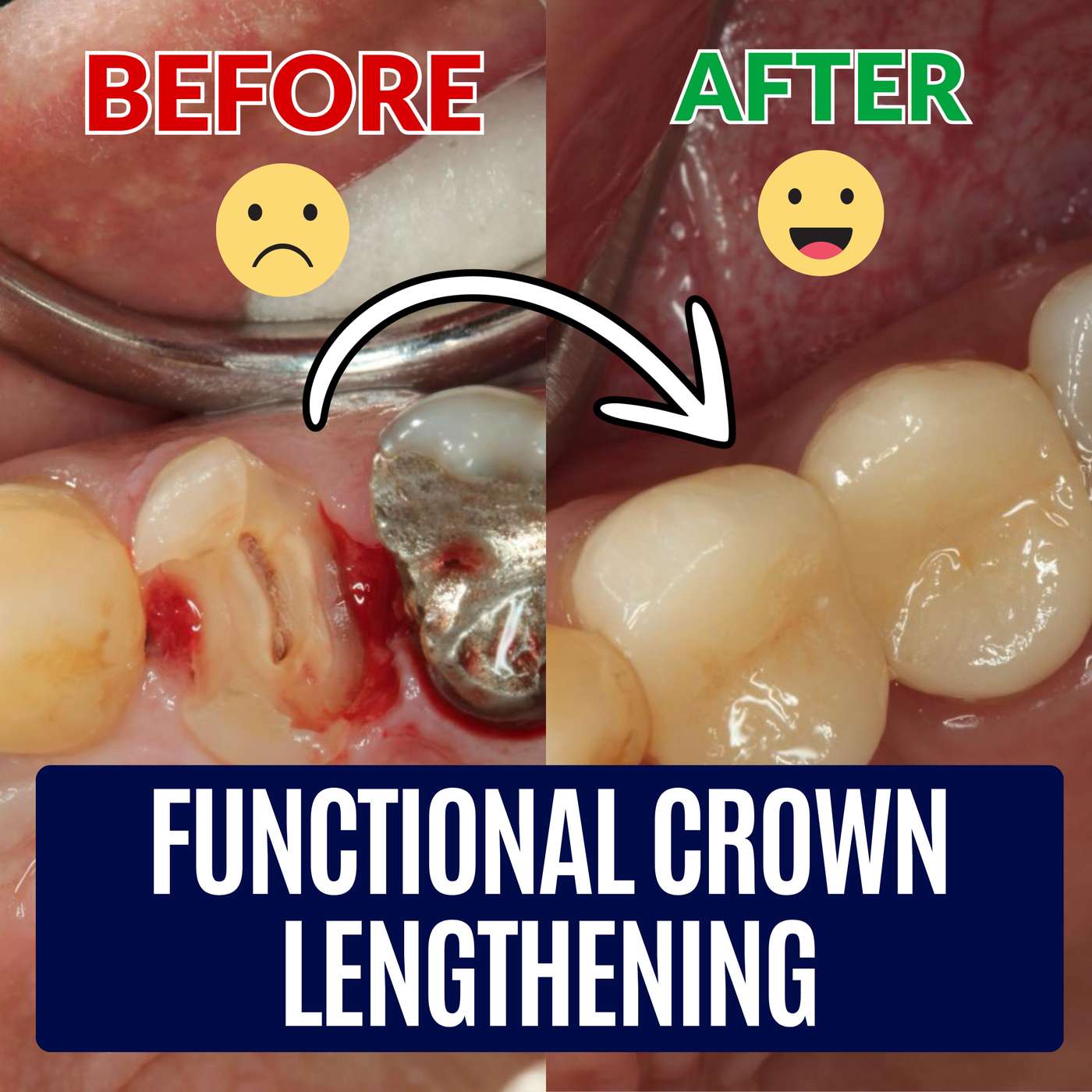 Step by Step Functional Crown Lengthening – PDP207 episode artwork