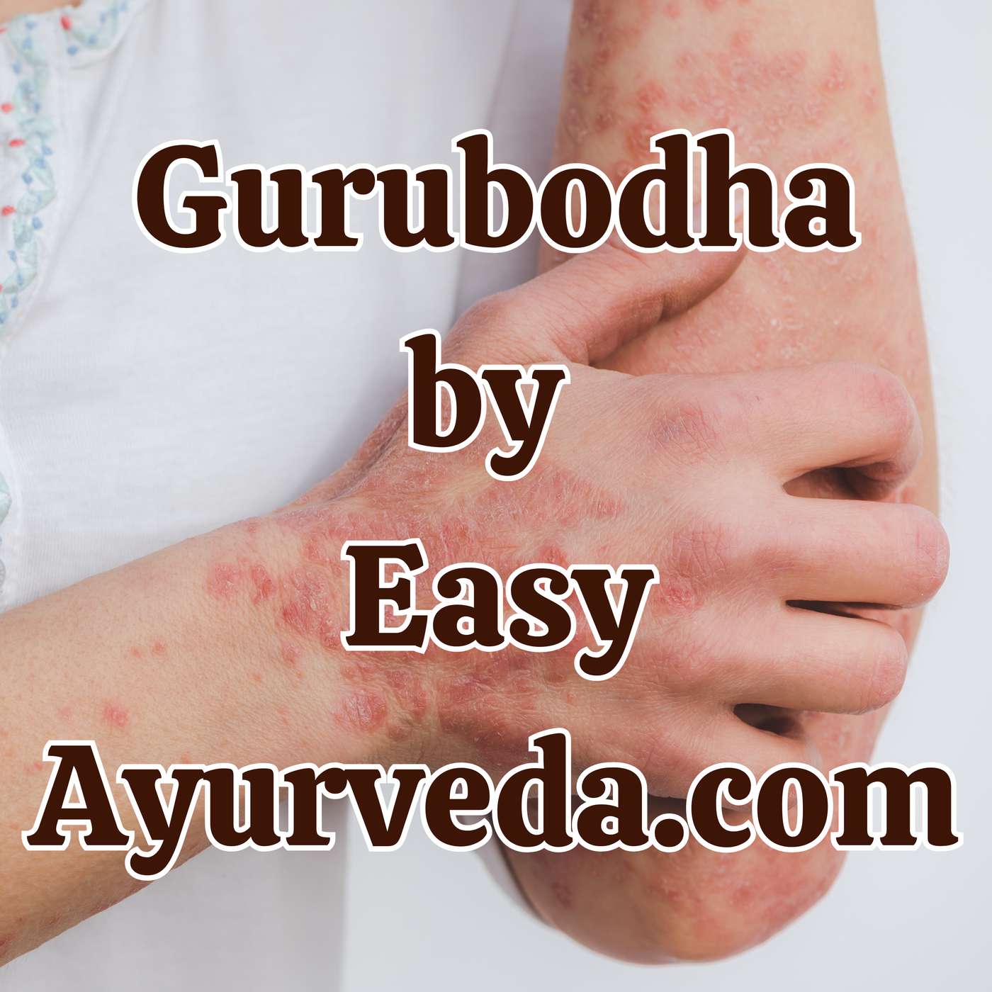 Gurubodha 176: MBBS BAMS Integration| Psoriasis Ayurveda Treatment - A Case study