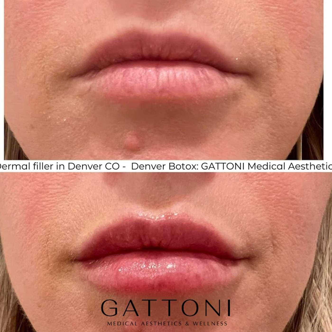 Dermal filler in Denver CO -  Denver Botox: GATTONI Medical Aesthetics episode artwork