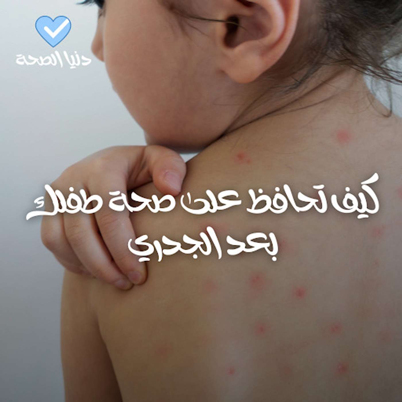كيف تحافظ على صحة طفلك بعد الجدري