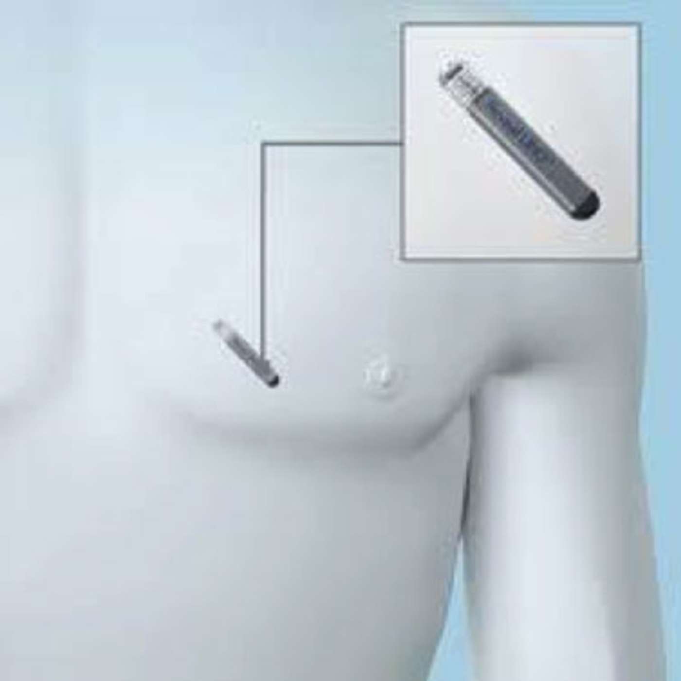 Implantable Loop Recorders (ILRs) in the Investigation of Syncope, Cryptogenic Stroke, TIA, and Transient Global Amnesia
