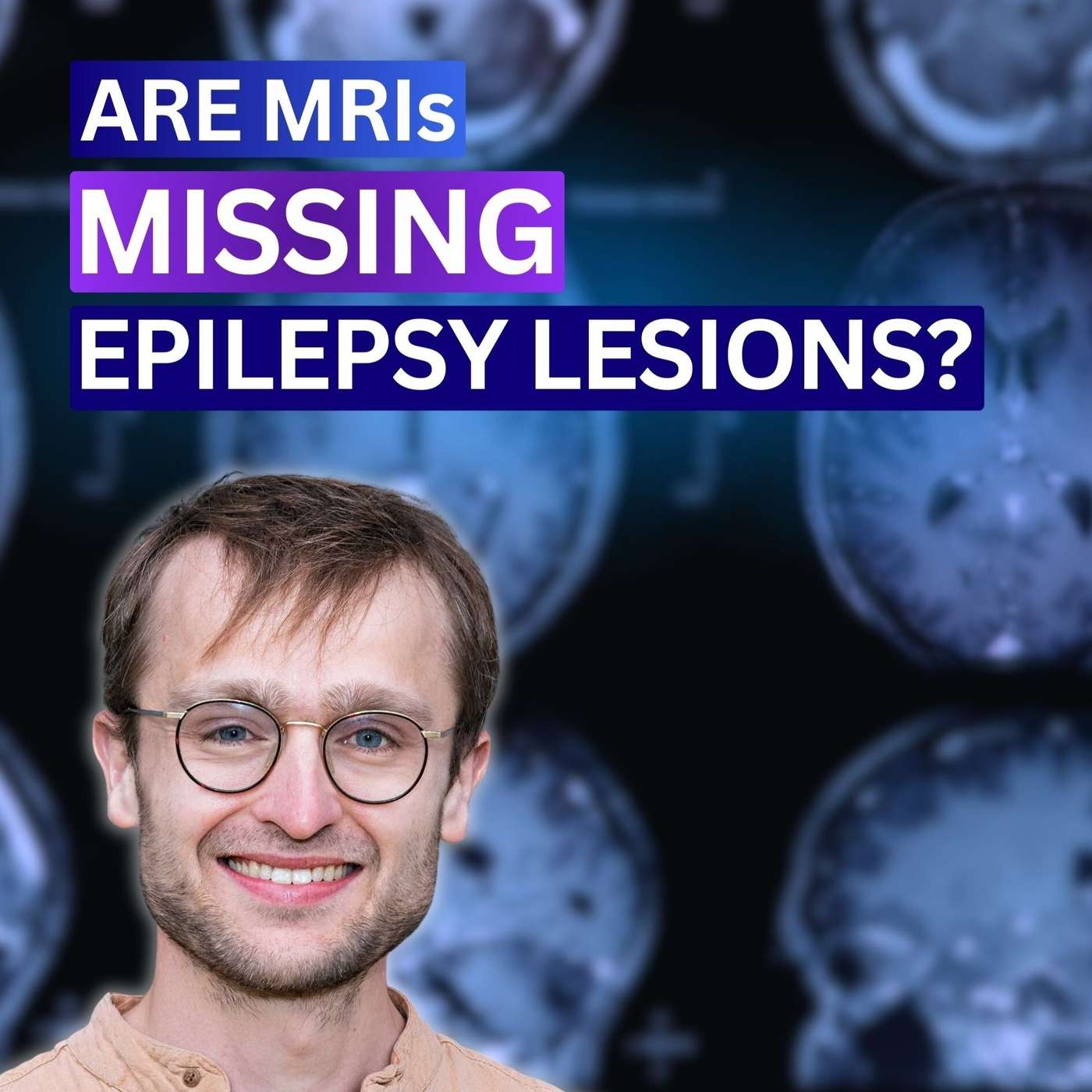MRIs Miss Brain Lesions Causing Epilepsy - AI Can Find Them - Dr. Konrad Wagstyl episode artwork