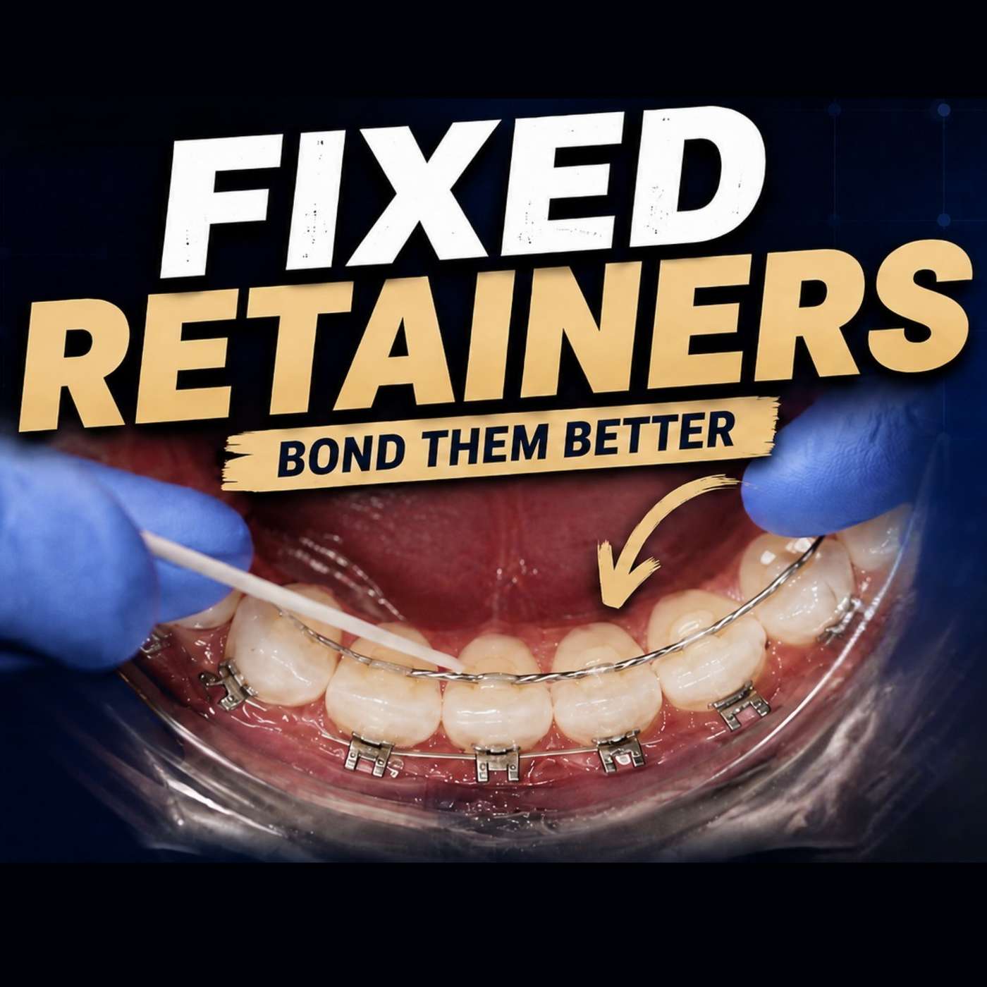 Fixed Retainers Demystified – PDP108 episode artwork