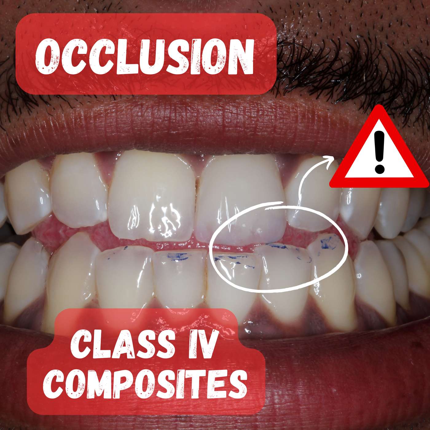 Occlusion on Class IV Composite Restorations – PDP150 episode artwork